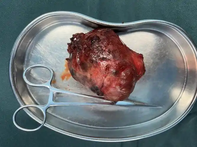 西安市中医医院外科成功切除乳房巨大肿瘤