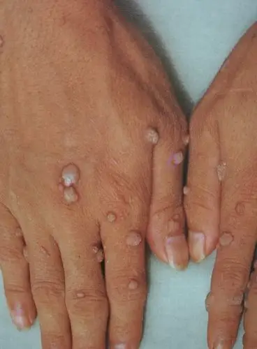 得了病毒疣不要急,看了这篇文章就清楚了