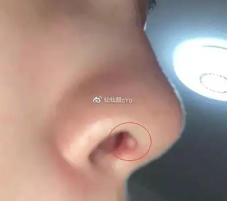 做了鼻子后出现增生变大正常吗? 为什么会出现增生?