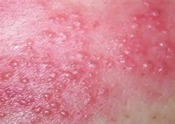 性病性淋巴肉芽肿套图 (46)_有来医生