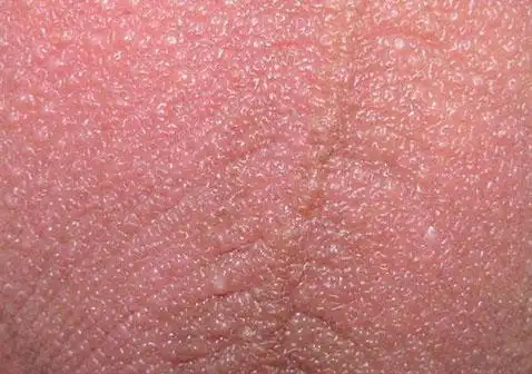 男人睾丸上长硬疙瘩图片及原因