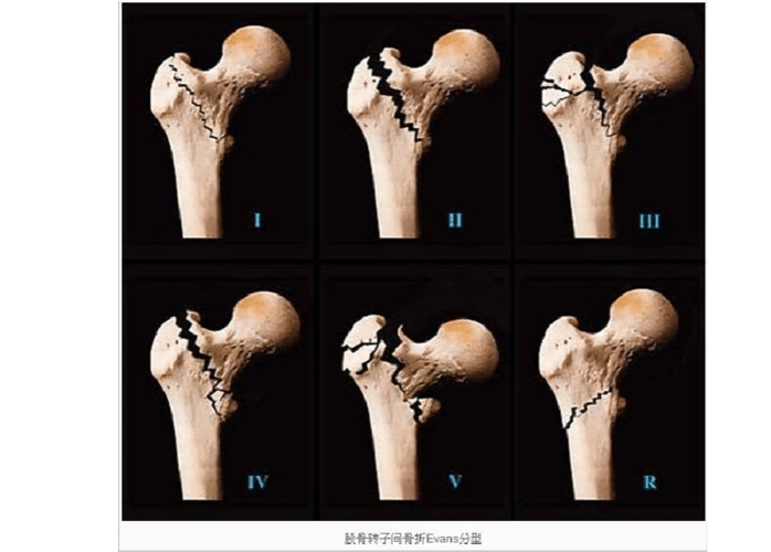 合并小转子撕脱骨折,但股骨距完整 Ⅲ型:合并大转子骨折,骨折累计股骨