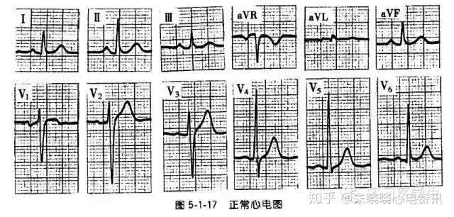 三.正常心电图