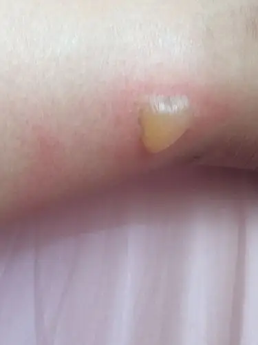 晚上睡觉脚被热水袋烫成这样了,要怎么处理比较好?