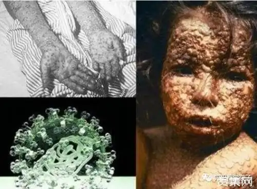 要说起这世界十大恐怖病毒,就算说不全,大