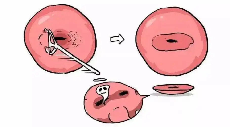 宫颈尖锐湿疣是归纳于什么科