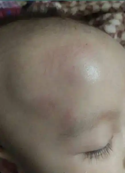 "宝宝头摔出一个鼓包,会伤到脑子吗?要不要做ct?_孩子头