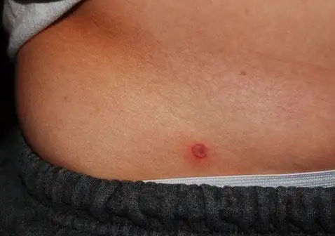 第二阶段梅毒早期症状图片皮疹