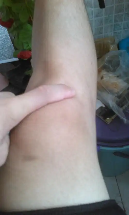 问:右脚膝盖右边的小窝会酸.