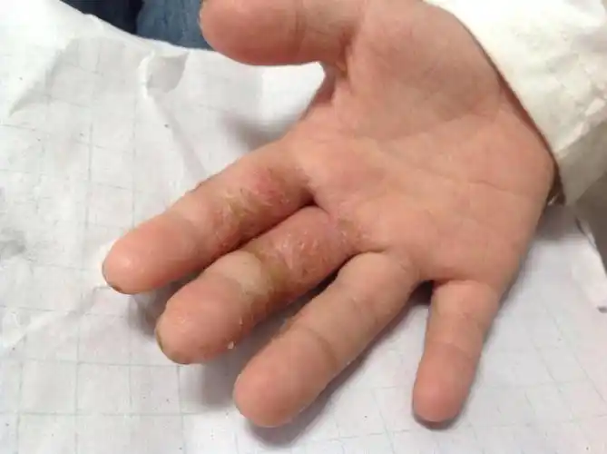 小儿手部顽固皮肤病. - 皮肤及性传播疾病讨论版 - 爱爱医医学论坛