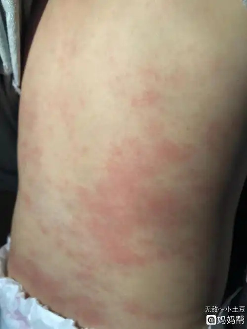 婴幼儿急疹,麻麻们淡定! - 2019年9月出生帮 - 妈妈帮