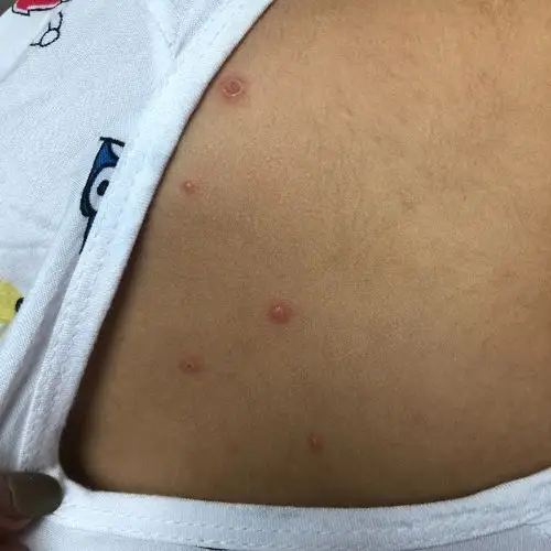 头上背上都长了像水痘一样的东西,破了有水,不痛不痒,请问是什么病症?