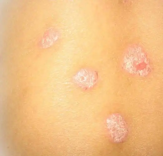 寻常型牛皮癣词条图册_百度百科