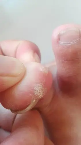 大母脚趾头长了两个白色疙瘩,很硬.不疼不痒,请问有知道怎么引起的