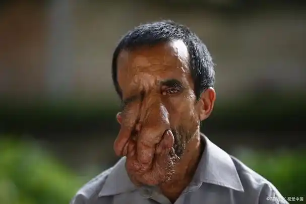 近日,一则关于一名3岁男孩患上罕见的象鼻病的消息引起了人们的广泛