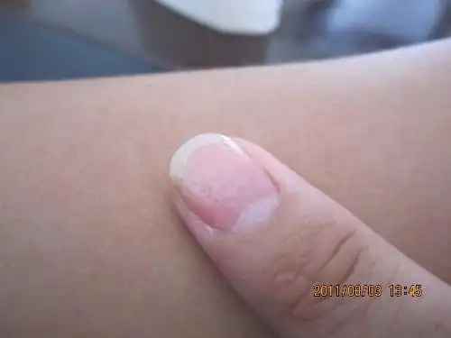 儿子指甲上有竖纹,和针眼样的小坑,是怎么会事?