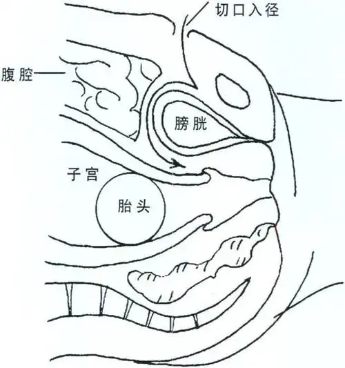(二) waters顶入式 (waters cesarean section)-产科手术技术-医学