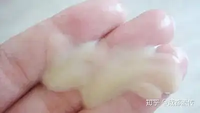 病态遗精,一定要治疗?