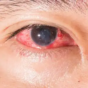 光眼子结膜炎眼测试照片