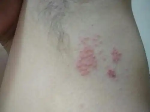 腋下长红色小痘痘