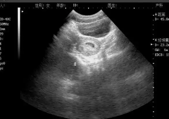 早期确定妊娠的 a href="#" data-lemmaid="687882">b超 /a>诊断依据