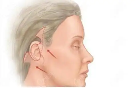 二,dgs四维青春复原术和v6面部拉皮哪个好?切口大小对比