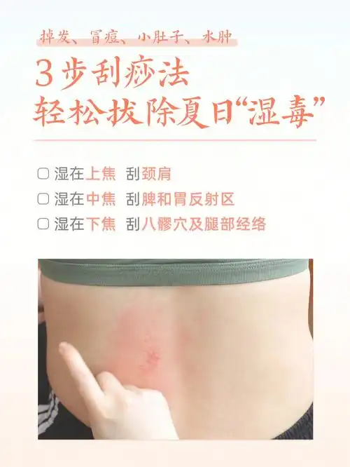 3步刮痧法|轻松拔除夏日"湿毒"
