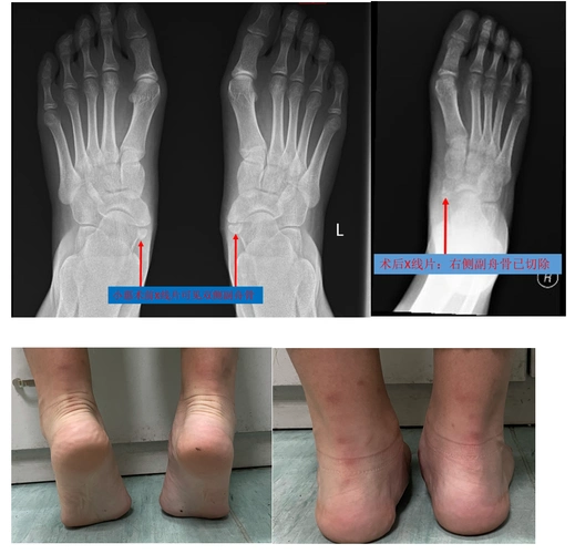 儿童少年时期脚痛的常见原因:副舟骨