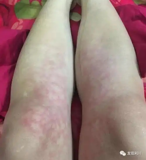 她说:最近天天用小太阳取暖器烤火,没想到烤成这样,这么多火斑子,怎么