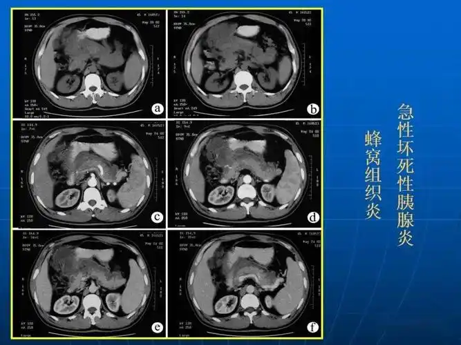 9种胰腺常见疾病的ct诊断