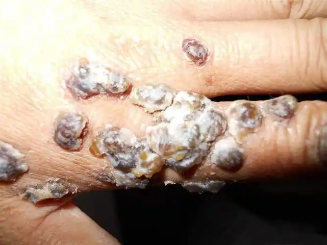 男性艾滋病症状手癣脚癣真菌感染