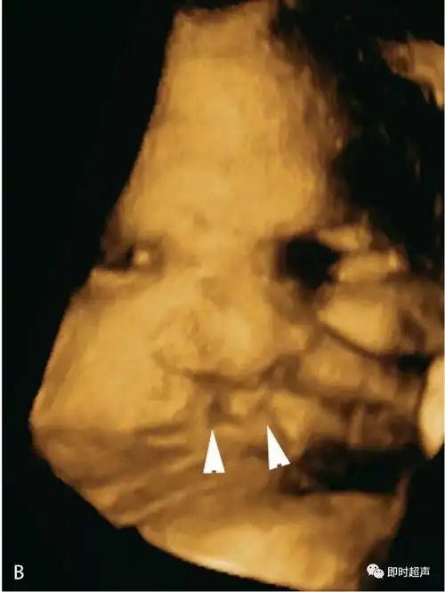 (b)同一胎儿的三维图像显示双侧唇裂(三角箭头).图6.1.