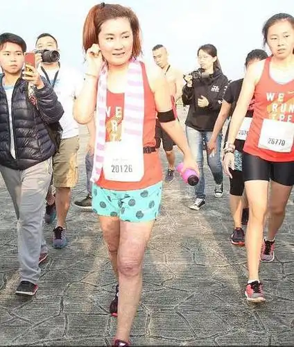 selina环状烧伤的腿现在康复成这样了