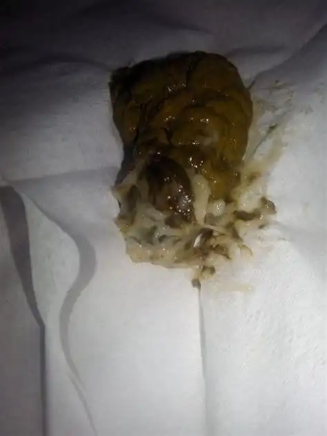 小孩大便拉出来有虫子小孩四五天不拉大便2022已更新今日图集