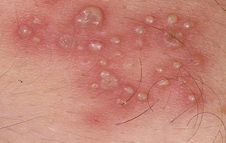 无症状hsv2携带者,会传播生殖器疱疹吗?