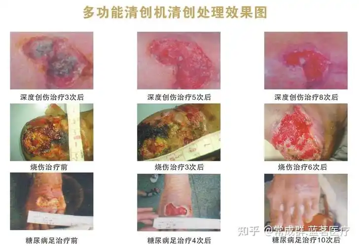 为什么超声清创系统可以提高清创效率