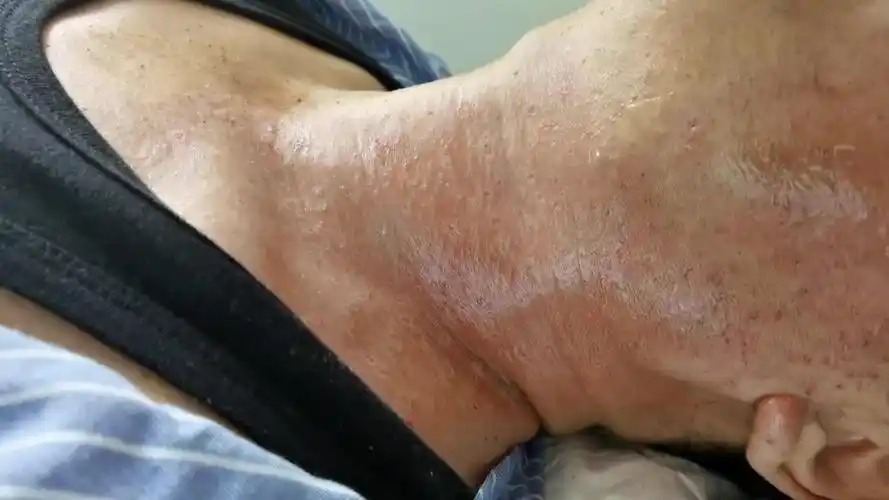 颈部扁平疣治疗后左右对比_扁平疣_扁平疣症状表现 - 好大夫在线