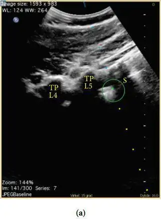 图2 腰骶隧道长轴超声图像