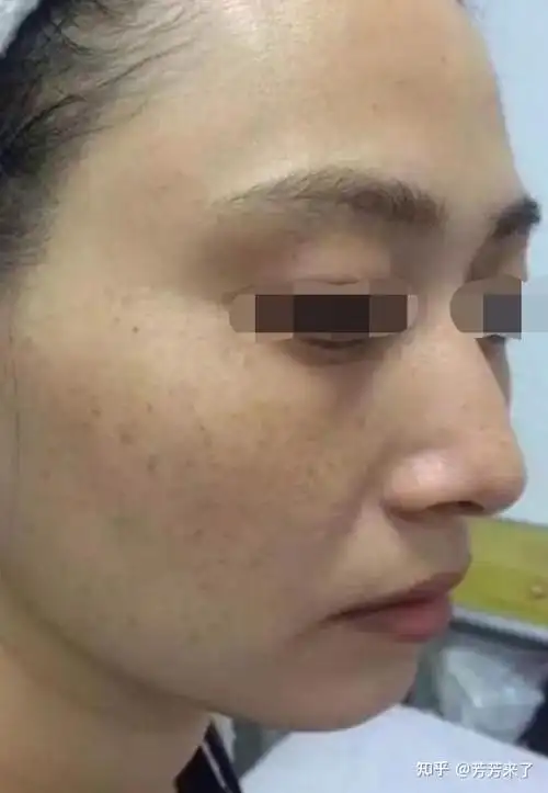 黄褐斑与雀斑的区别? - 知乎