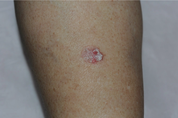 图4. 早期鳞状细胞癌---日光性角化症图5.