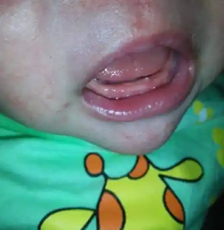 未满月25天的婴儿,嘴巴里面牙床上那个白点是什么?一直是母乳喂养.