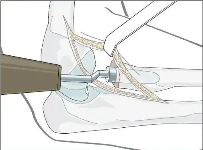 开封市第二中医院成功开展医院首例人工桡骨头置换术
