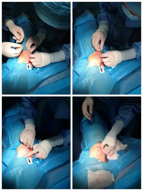 完成链接港体和底座,埋入皮下.