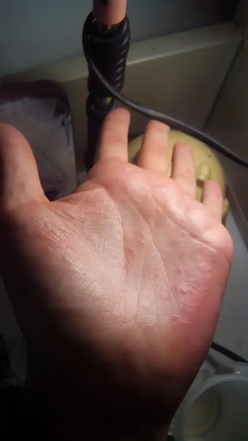手心长了很多小泡泡 特别痒 大概三个礼拜了