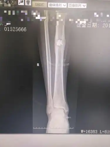 胫骨慢性骨髓炎