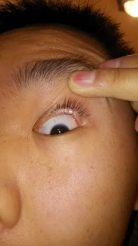 有人说是睑板腺堵塞.