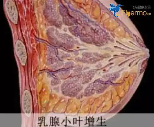 小叶增生常见于育龄妇女,大多数病人的症状是与月经相关的周期性乳房
