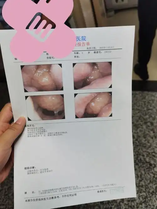 腺样体肥大手术