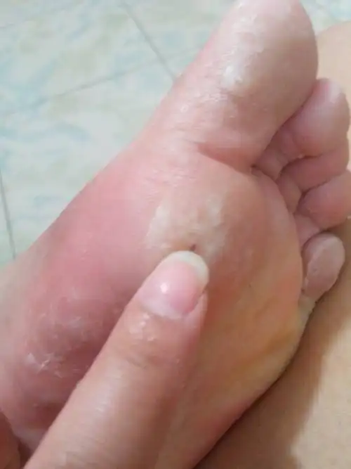 前脚掌疼,还肿了是怎么回事?大拇指顶头也有点疼有点肿.如何好的快?