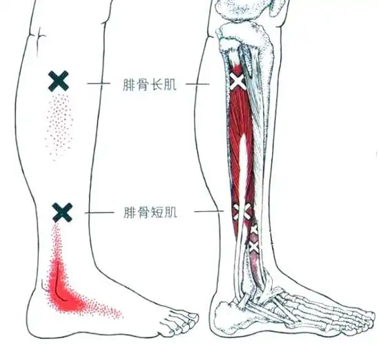 腓骨长肌解剖及激痛点 - 好大夫在线